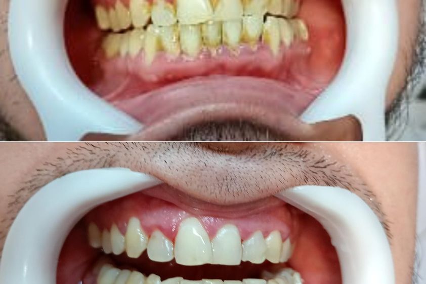 Limpieza dental antes y después - 871929