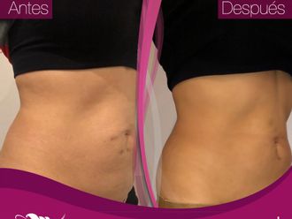 Mesoterapia antes y después - 794988