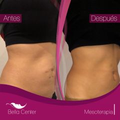 Mesoterapia - Bella Center