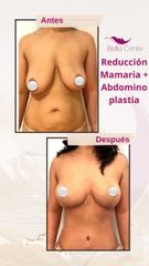 Reducción mamas - Bella Center