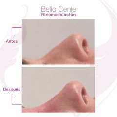 Rinomodelación - Bella Center