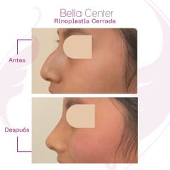 Rinoplastia - Bella Center