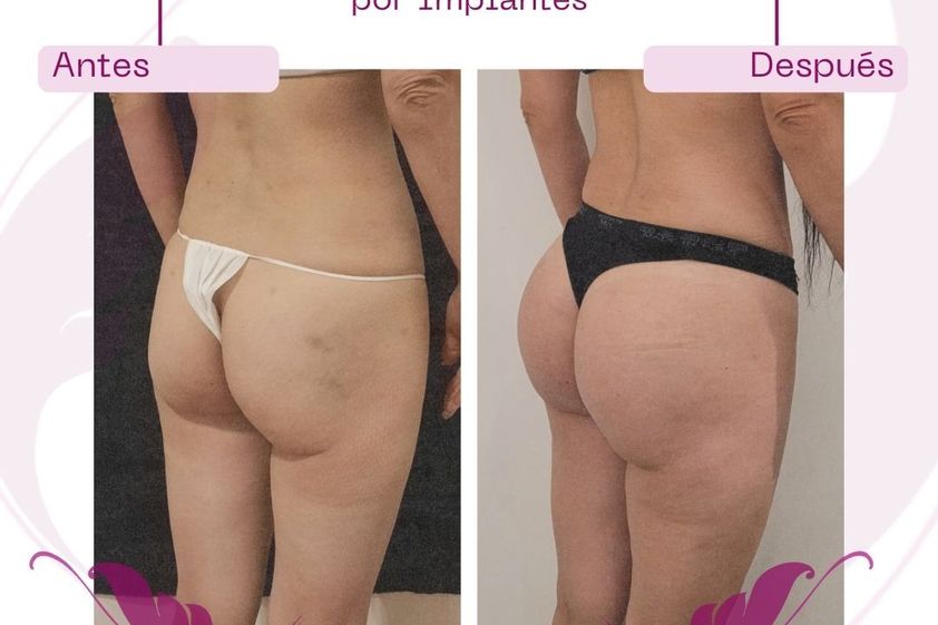 Aumento glúteos antes y después - 864542