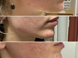 Rellenos faciales antes y después - 876945