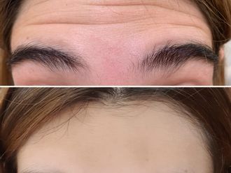 Botox antes y después - 876946