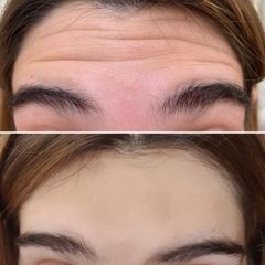 Botox - Dra. Janina María Abbud
