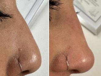 Rinomodelación antes y después - 876947