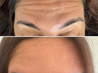 Botox antes y después - 876948