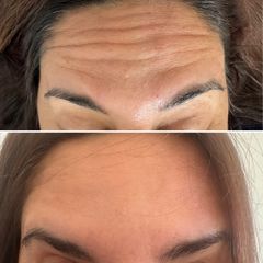 Botox - Dra. Janina María Abbud