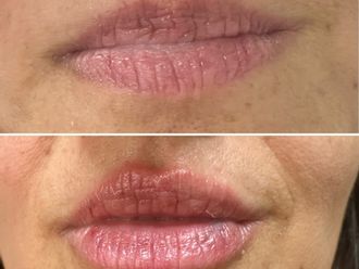 Ácido hialurónico antes y después - 876949