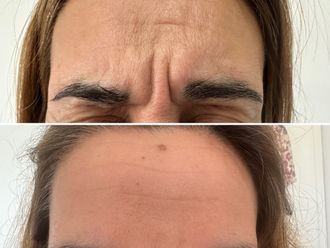 Botox antes y después - 876950