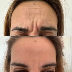 Botox - Dra. Janina María Abbud