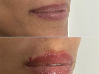 Relleno de labios antes y después - 876951