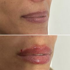 Rellenos de Labios - Dra. Janina María Abbud