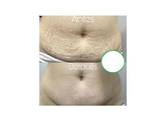 Carboxiterapia antes y después - 635700