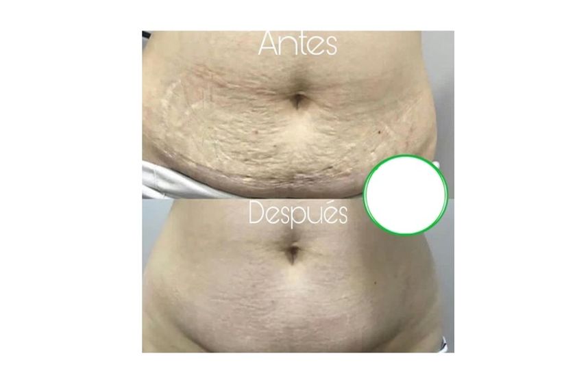 Carboxiterapia antes y después - 635700