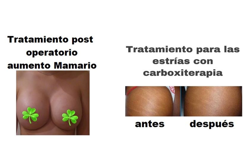 Carboxiterapia antes y después - 635701