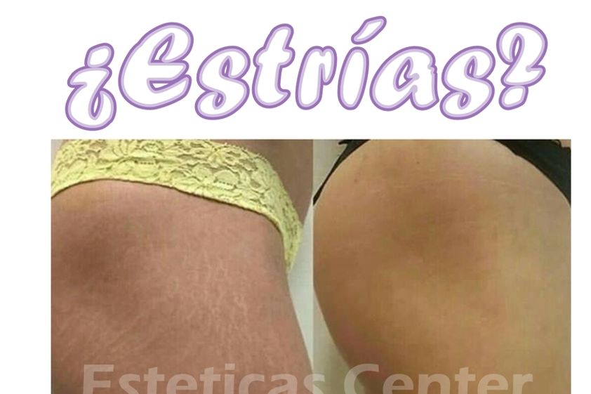 Carboxiterapia antes y después - 636292