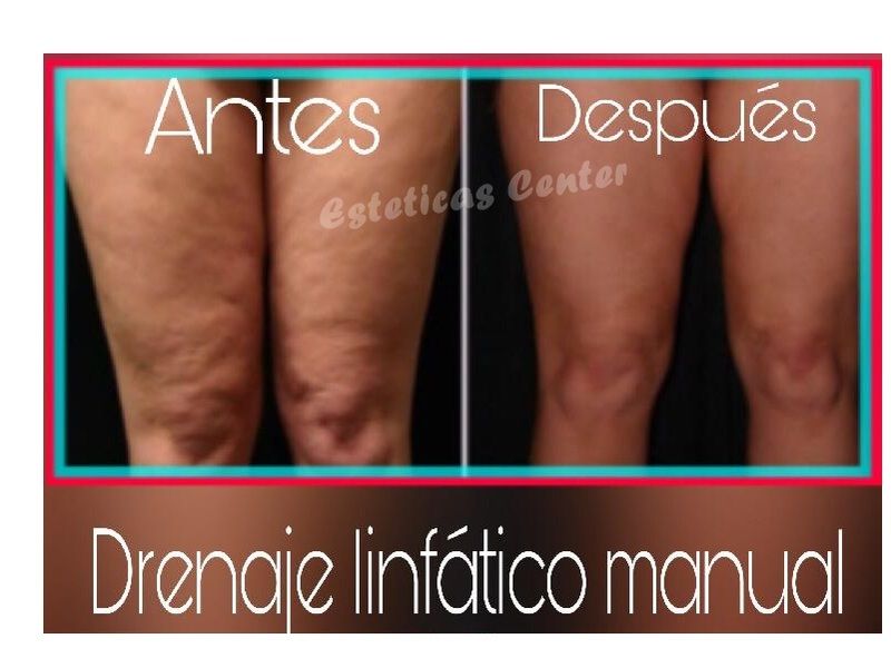 Drenaje linfático en piernas: antes y después - Centro Médico Estético  Rusiñol