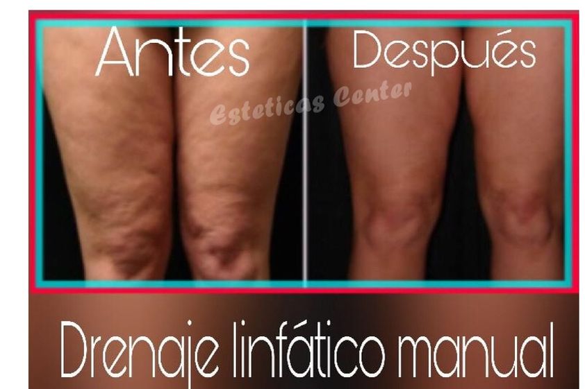 Drenaje linfático antes y después - 636294
