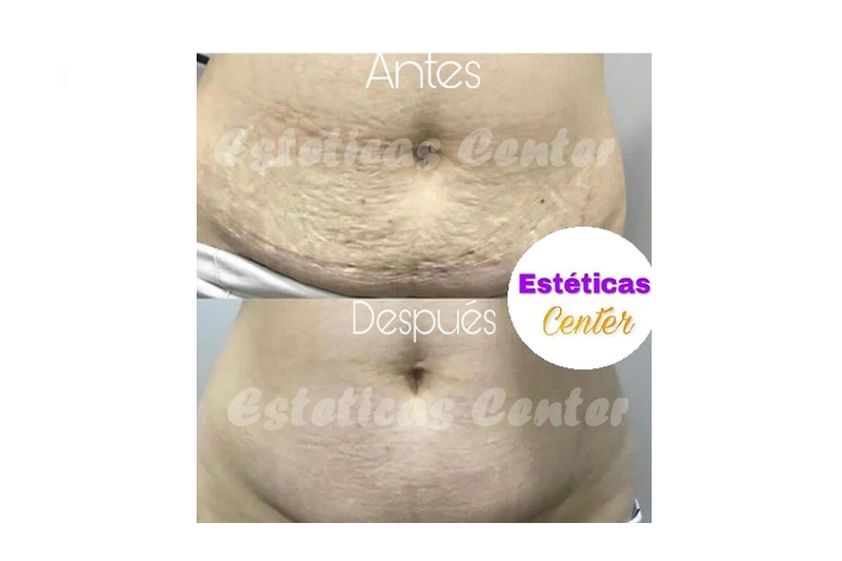 Carboxiterapia antes y después - 636297