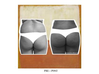 Lipo + Lipotransferencia glutea