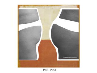 Lipo + Lipotransferencia glutea