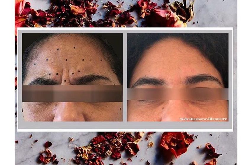 Plasma Rico en Plaquetas antes y después - 644643