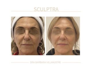 Sculptra - Dra. Barbara Villanustre