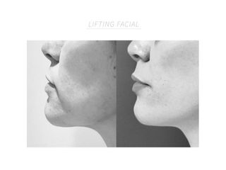 Lifting facial - Dra.Barbara Villanustre