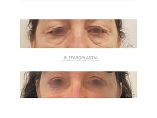 Blefaroplastia - Dra Barbara Villanustre