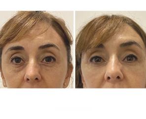 Blefaroplastia - Dra Barbara Villanustre