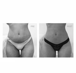Liposucción - Dra Barbara Villanustre