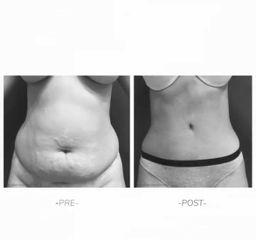 Abdominoplastia - Dra Barbara Villanustre