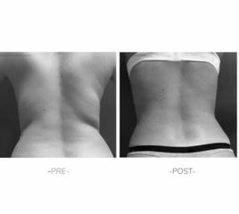 Abdominoplastia - Dra Barbara Villanustre