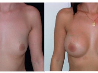 Antes y despues de implantes mamarios