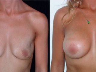 Antes y despues de implantes mamarios