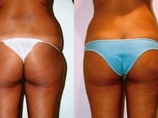 Antes y despues de lipoescultura