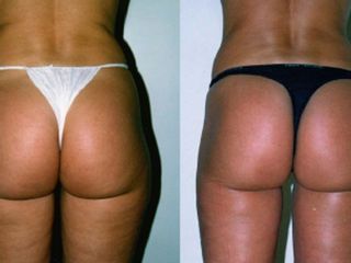 Antes y despues de lipoescultura