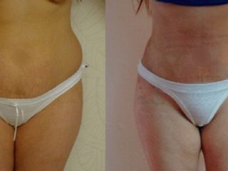 Antes y despues de abdominoplastia