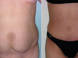 Antes y despues de abdominoplastia