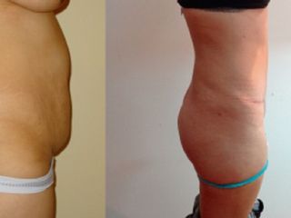 Antes y despues de abdominoplastia