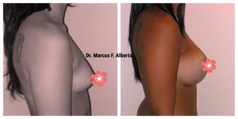 Aumento mamario - Dr. Marcos F. Alberto