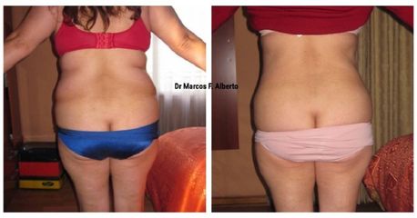 Liposucción - Dr. Marcos F. Alberto