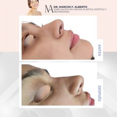 Rinoplastia - Dr. Marcos F. Alberto