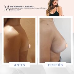 Aumento mamas - Dr. Marcos F. Alberto