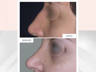 Rinoplastia antes y después - 870543