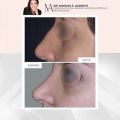 Rinoplastia - Dr. Marcos F. Alberto