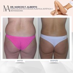 Liposucción - Dr. Marcos F. Alberto