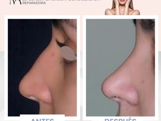 Rinoplastia antes y después - 870548